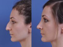 before and after rhinoplasty female patient left side view case 2139
