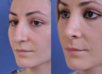 before and after rhinoplasty female patient left angle view case 2139