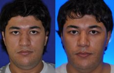 before and after rhinoplasty male patient front view case 2212