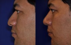 before and after rhinoplasty male patient left side view case 2212