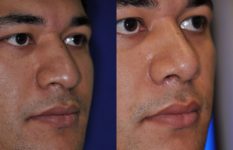 before and after rhinoplasty male patient closeup right angle view case 2212