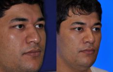 before and after rhinoplasty male patient right angle view case 2212