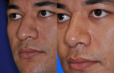 before and after rhinoplasty male patient left angle view case 2212