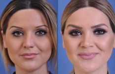 before and after rhinoplasty female patient front view case 2247