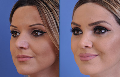 before and after rhinoplasty female patient left angle view case 2247