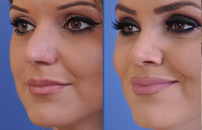 before and after rhinoplasty female patient left angle view case 2247