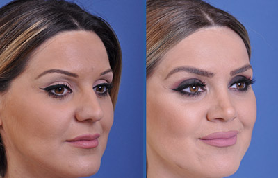 before and after rhinoplasty female patient right angle view case 2247