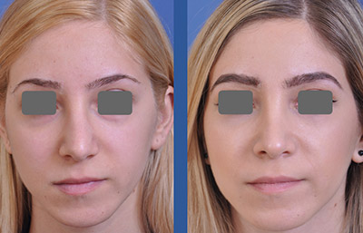 before and after rhinoplasty female patient front view case 2253
