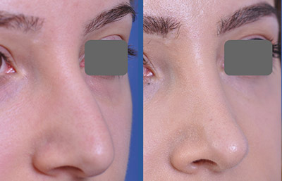 before and after rhinoplasty female patient right angle view case 2253
