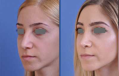 before and after rhinoplasty female patient left angle view case 2253
