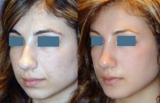 before and after rhinoplasty female patient left angle view case 2259