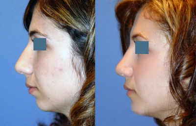 before and after rhinoplasty left side view case 2259