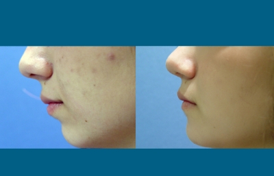 before and after rhinoplasty left side view case 2259