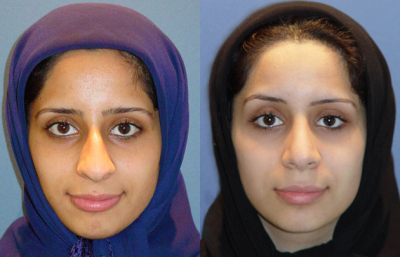 before and after rhinoplasty female patient front view case 2265