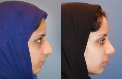 before and after rhinoplasty female patient right side view case 2265