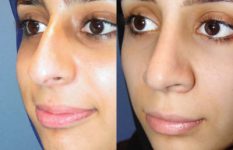 before and after rhinoplasty female patient left angle view case 2265