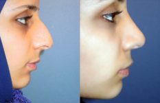 before and after rhinoplasty female patient right side view case 2265