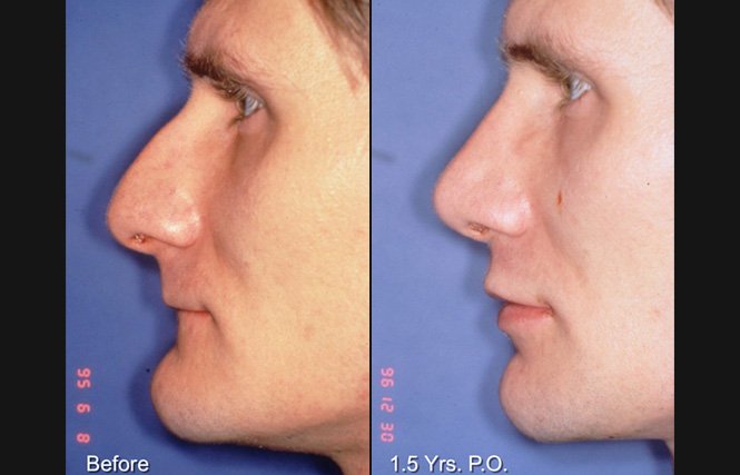 before and after rhinoplasty male patient left side view case 2294
