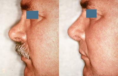 before and after rhinoplasty male patient left side view case 2296