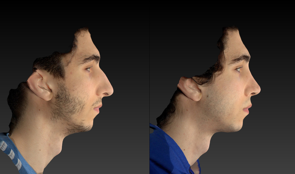before and after rhinoplasty male patient right side view case 3007