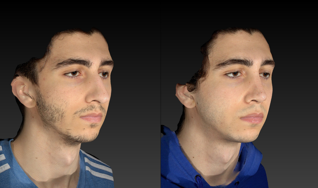 before and after rhinoplasty male patient right angle view case 3007