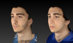 before and after rhinoplasty male patient left angle view case 3007