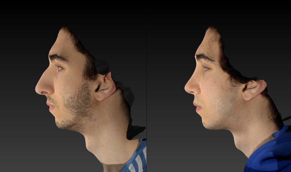 before and after rhinoplasty male patient left side view case 3007