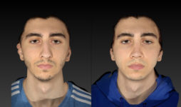 before and after rhinoplasty male patient front view case 3007
