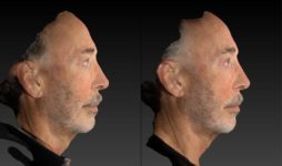 before and after rhinoplasty male patient right side view case 3139