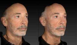 before and after rhinoplasty male patient right angle view case 3139