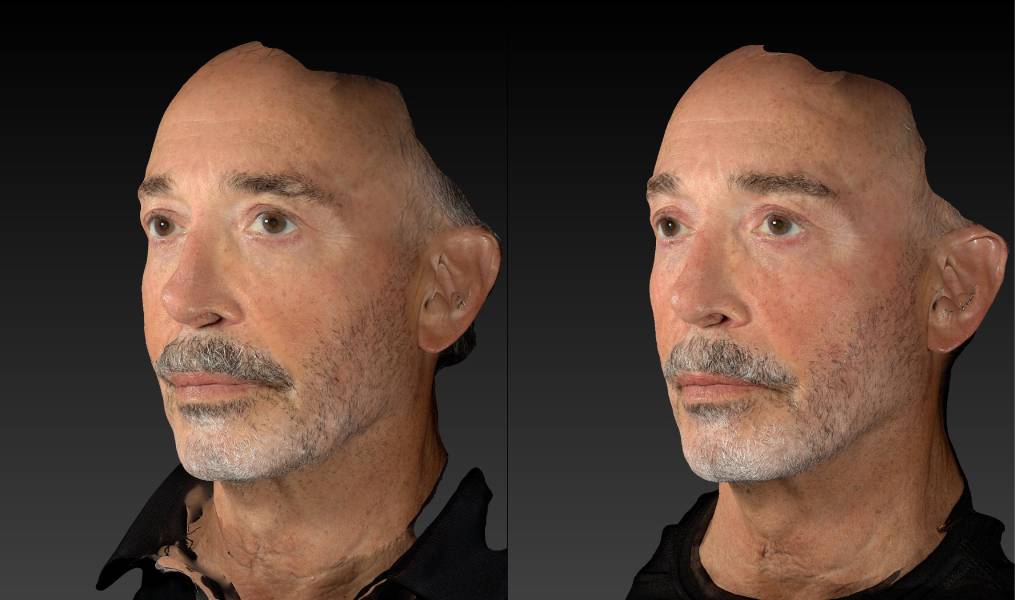 before and after rhinoplasty male patient left angle view case 3139