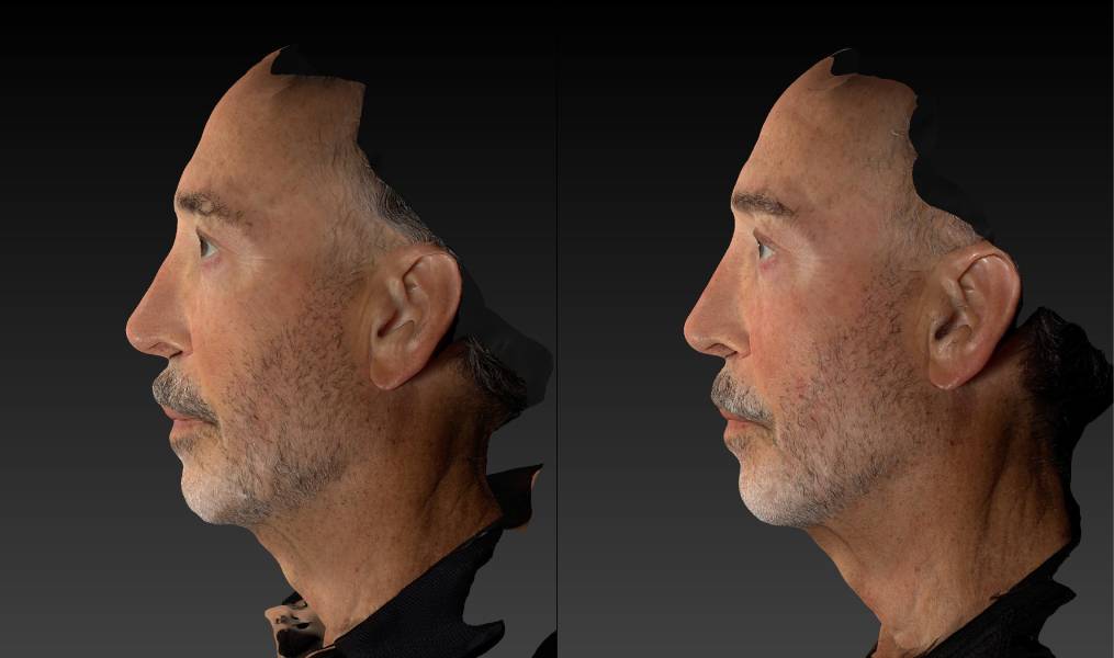 before and after rhinoplasty male patient left side view case 3139