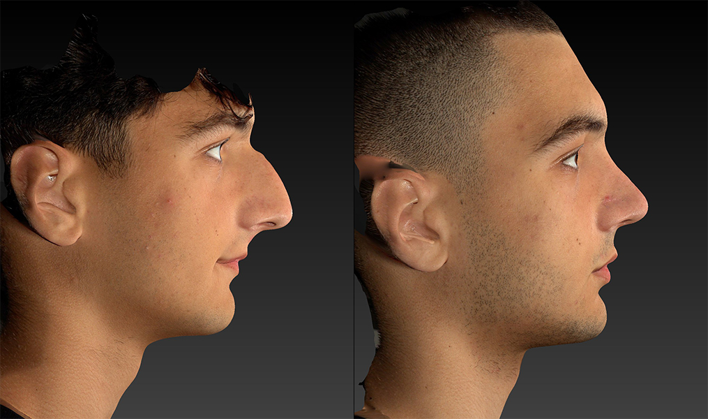 before and after rhinoplasty male patient right side view case 3153