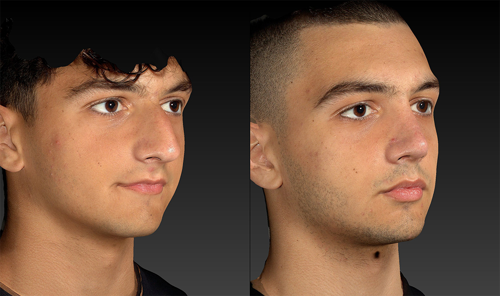before and after rhinoplasty male patients right angle view case 3153