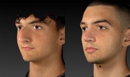 before and after rhinoplasty male patient left angle view case 3153