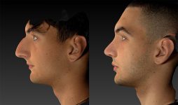 before and after rhinoplasty male patient left side view case 3153