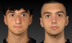 before and after rhinoplasty male patient front view case 3153