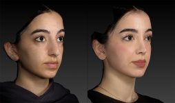 before and after rhinoplasty female patient right angle view case 3052