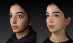 before and after rhinoplasty female patient left angle view case 3052
