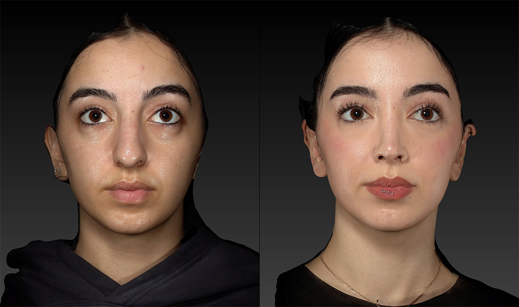 before and after rhinoplasty female patient front view case 3052