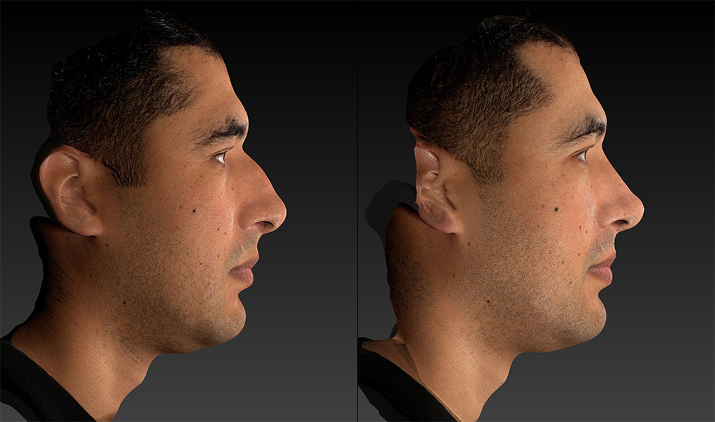 before and after rhinoplasty male patient right side view case 3620