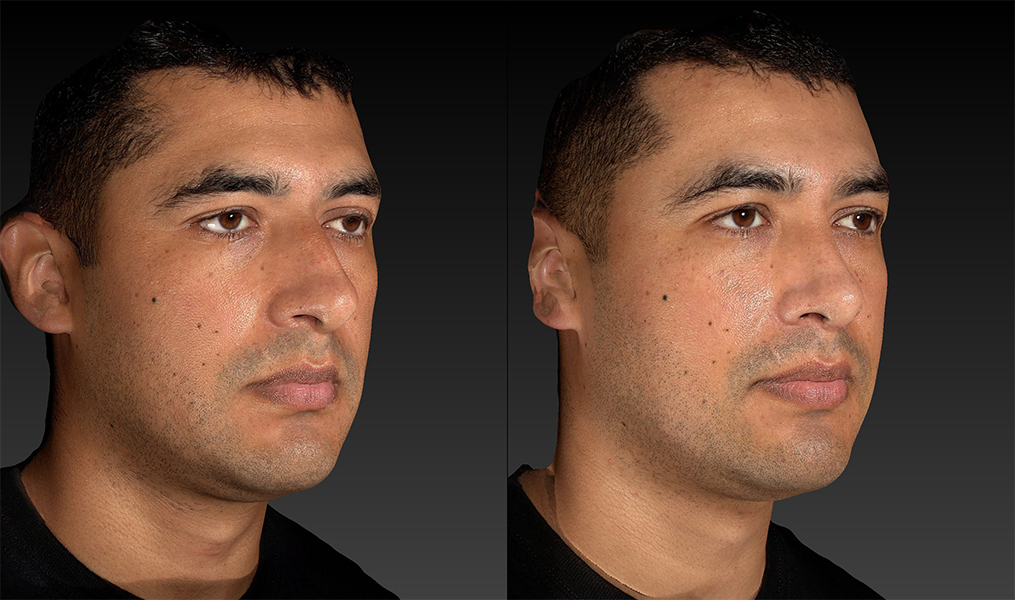 before and after rhinoplasty male patient right angle view case 3620
