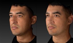 before and after rhinoplasty male patient left angle view case 3620