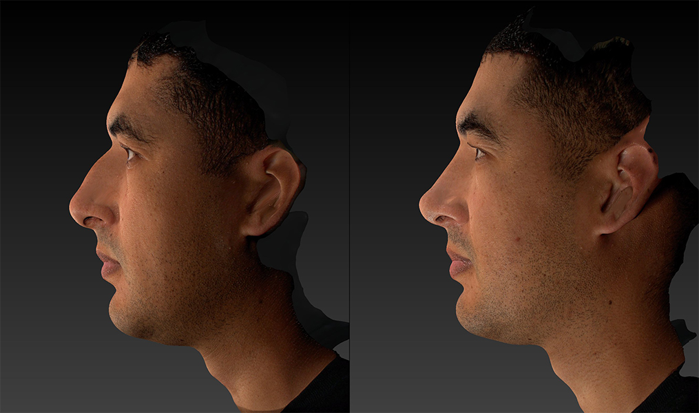 before and after rhinoplasty male patient left side view case 3620