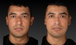 before and after rhinoplasty male patient front view case 3620