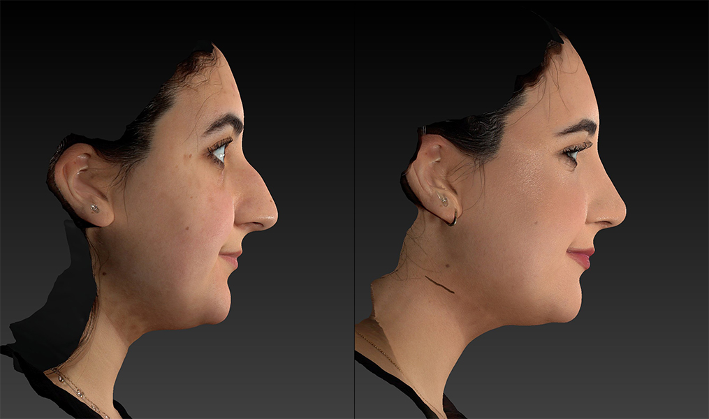 before and after rhinoplasty right side view female patient case 3636