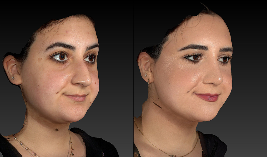 before and after rhinoplasty right angle view female patient case 3643
