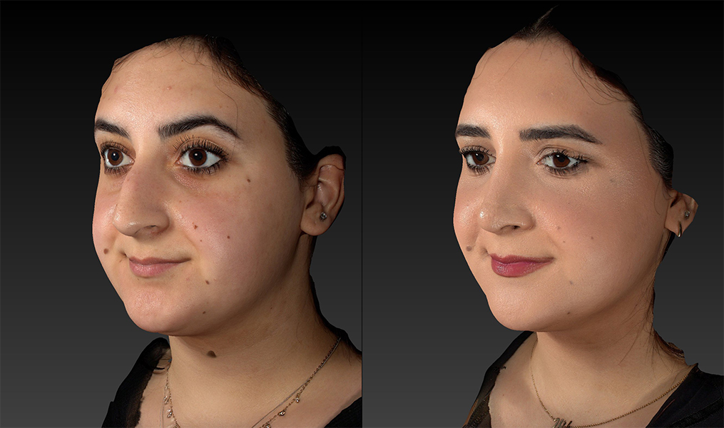 before and after rhinoplasty left angle view female patient case 3643