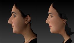 before and after rhinoplasty left side view female patient case 3643
