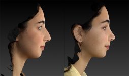 before and after rhinoplasty right side view female patient case 3643